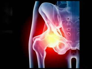 DePuy Hip Recall - Seeking Assistance