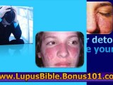 symptoms of lupus - systemic lupus