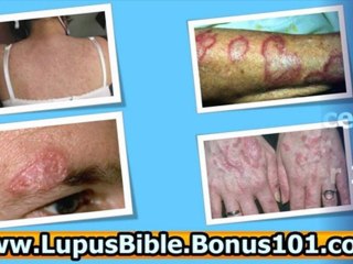 lupus treatment - lupus treatments - reverse lupus now