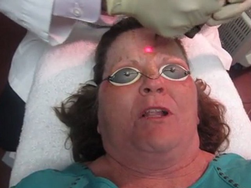 Facial Skin Resurfacing and Laser Peel With Fotona Laser-Valley Aesthetics and Laser-Hacienda Heights