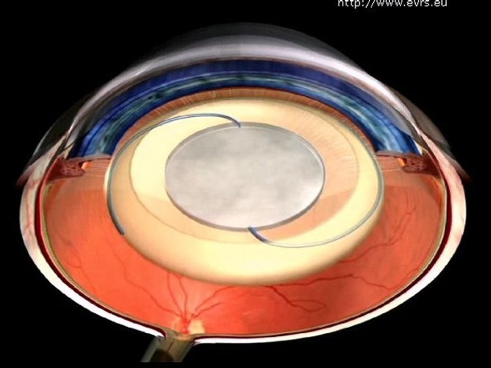 Cataract
