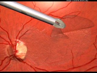 Macular Edema   & Membrane