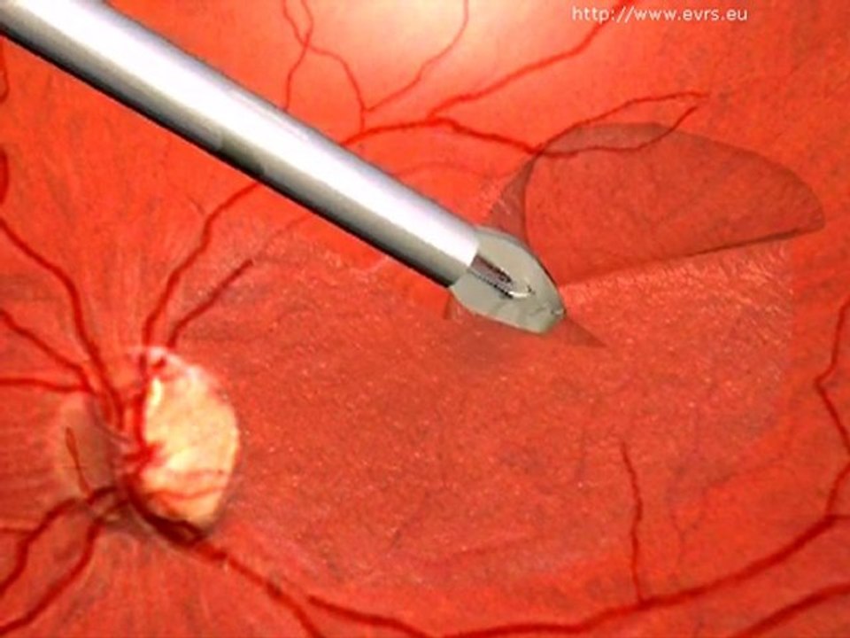 Síndromes    maculares