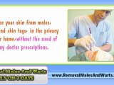 Removal Moles & Warts - Any part of your body