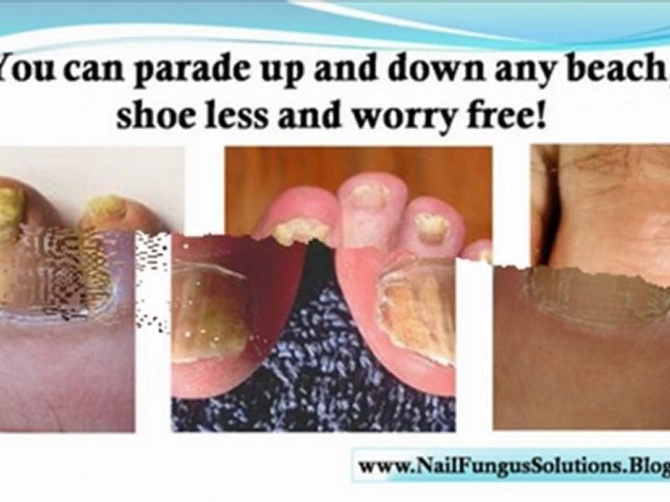 how to treat nail fungus - nail fungus home remedy - cure for nail fungus