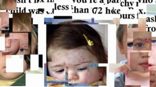 treatment for chicken pox - chicken pox in children - how to treat chicken pox