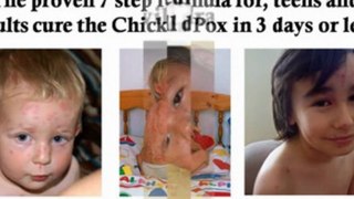 chicken pox treatment for adults - how long is chicken pox contagious - chicken pox symptoms in babies