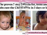 chicken pox treatment for children - chicken pox symptoms in adults - chicken pox contagious period