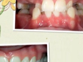 Orthodontist Parker CO New Smiles July 2011