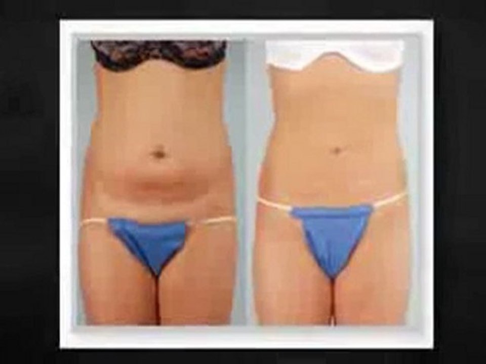 Laser Liposuction