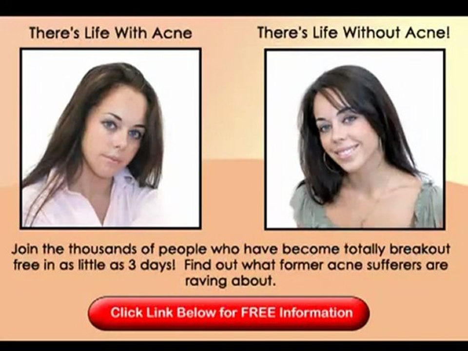 BEST ACNE TREATMENT In 3 Days - Get Rid of Acne