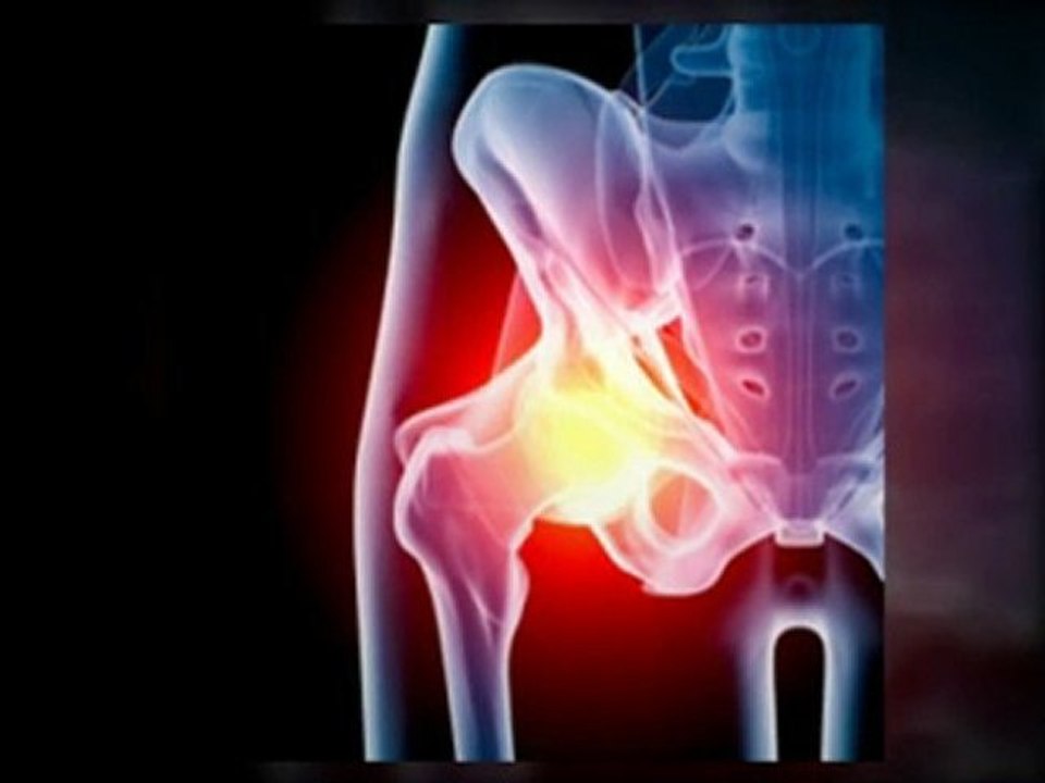What You Have to Do if You Have a Faulty DePuy Hip