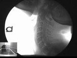 Dislocated neck missed on MRi and X-ray from a car accident
