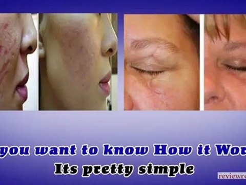 Revitol Scar Cream for Acne Scar Removal & Treatment-Before a Costly Option