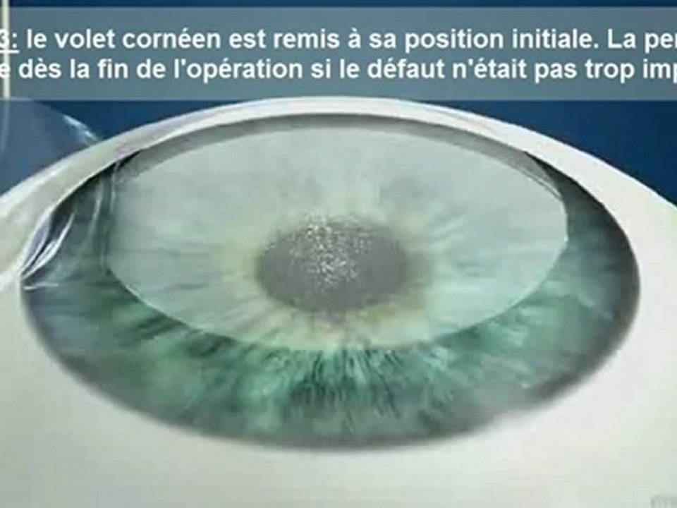 VIDEO correction defauts de l oeil : le LAZIK