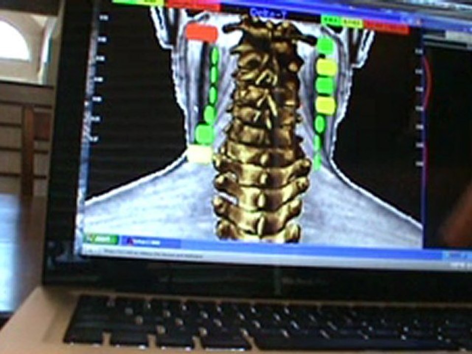 Dacula, Hamilton Mill ga - HIP PAIN RELIEF - Upper Cervical Chiropractic