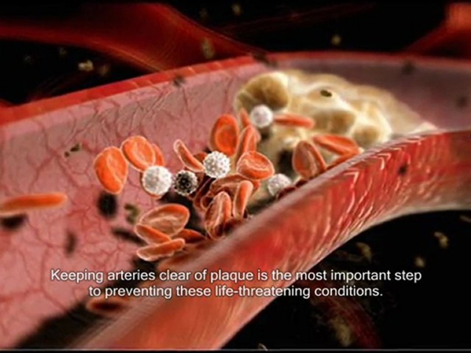How to clear arteries of plaque