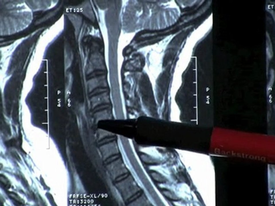 Neck Pain MRI scan Atlanta, & Spinal decompression physical therapy, chiropractor treatment