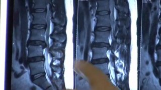 Low Back MRI scan explaining low back pain, herniated and degenerated discs, & spinal decompression physical therapy & chiropractor treatment
