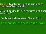 The Scar Solution - Exposed, How To Remove Acne Scars