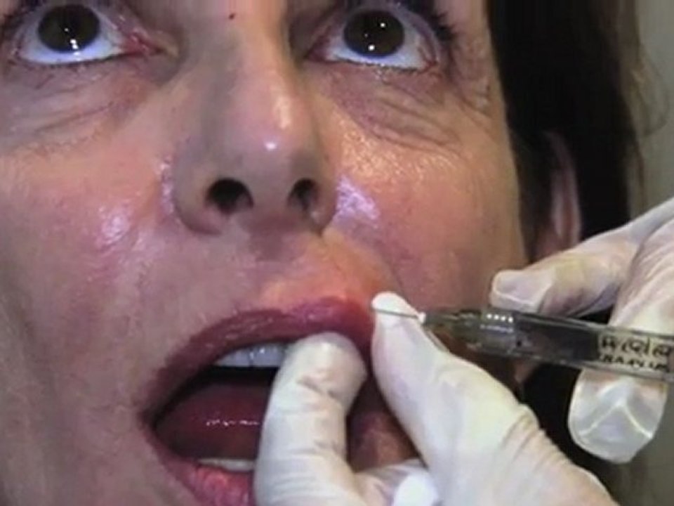 My journey continues with nonsurgical face lift