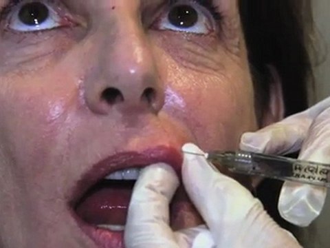 My journey continues with nonsurgical face lift