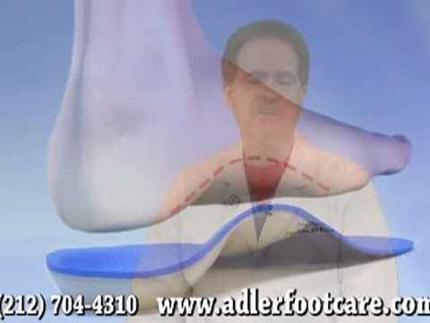 Custom Orthotic - NYC Podiatrist Manhattan and White Plains