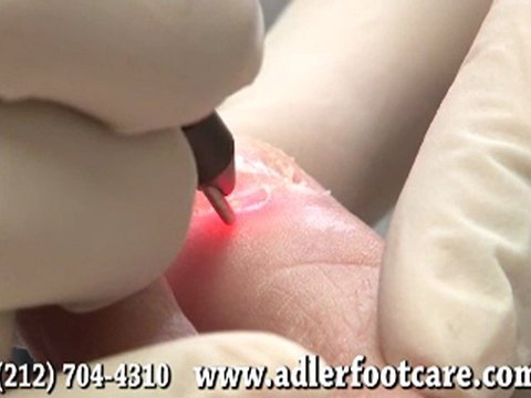 Laser Treatment for Toenail Fungus - NYC Podiatrist Manhatt