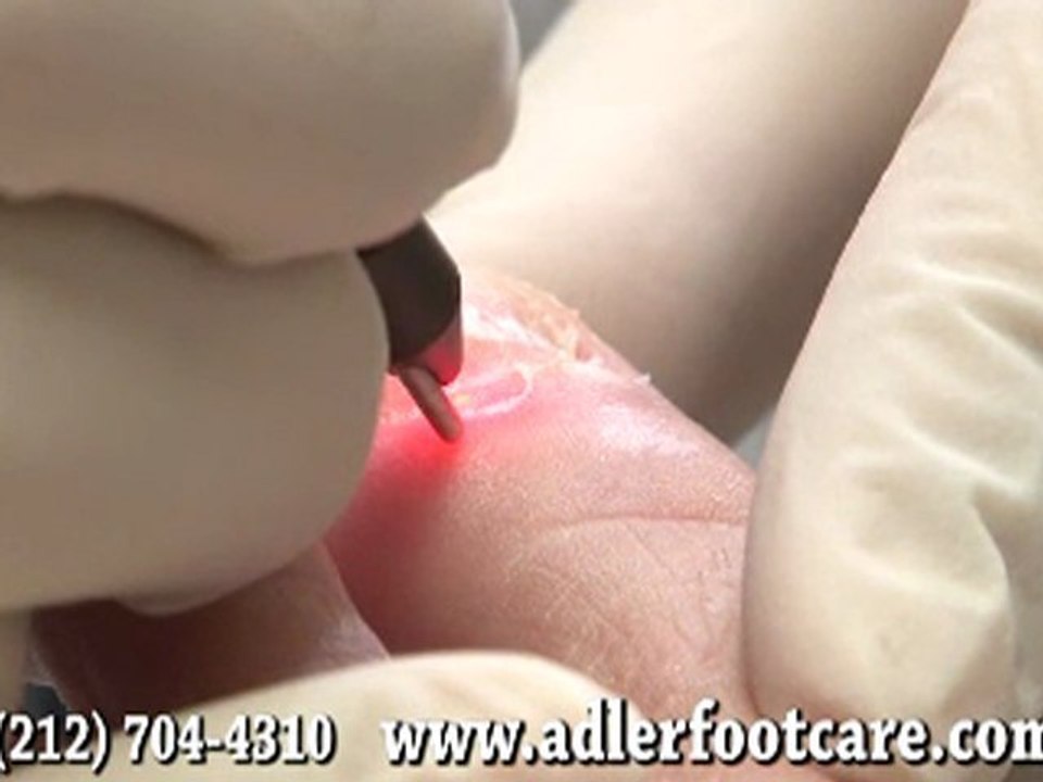 Laser Treatment for Toenail Fungus  - NYC Podiatrist Manhatt