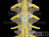 Lumbar Spinal Cord Neuro-stimulation paddle electrode personal injury movies