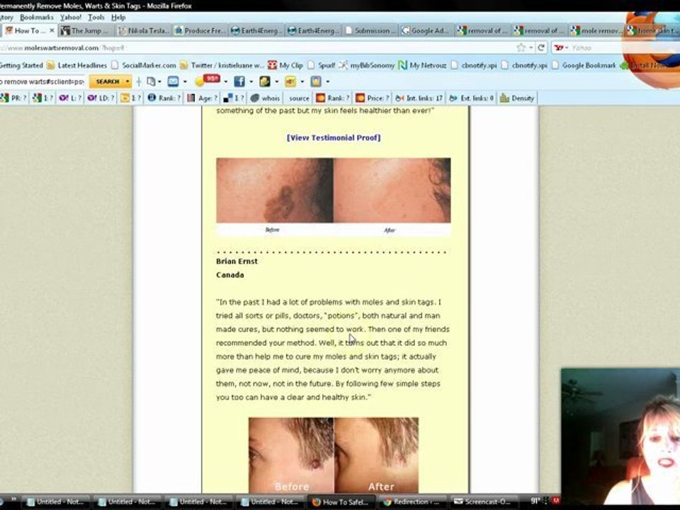 Removing Moles from Skin