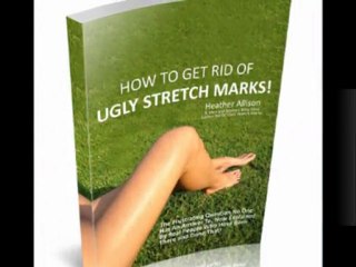 Get Rid of Ugly Stretch Marks