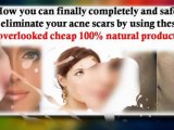 natural treatments for acne - best natural acne treatment
