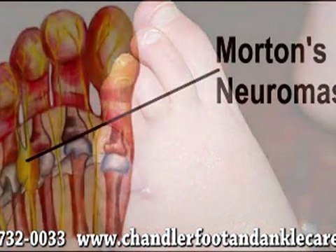 Podiatrist in Chandler, Sun Lakes and Phoenix, AZ - Alan Dis