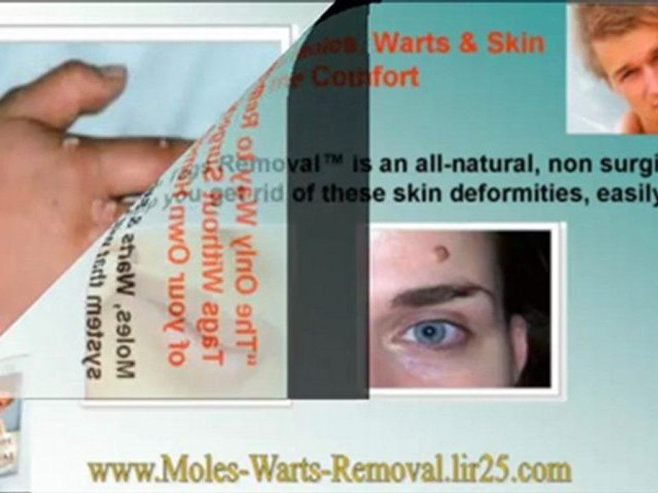how to remove a wart - wart remover - wart treatment