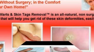 how to remove moles - how to remove skin tags - how to remove warts