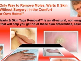 how to remove moles - how to remove skin tags - how to remove warts