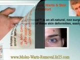 treatment for genital warts - genital warts cure - best wart remover