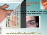 warts removal - warts treatment - genital wart remover