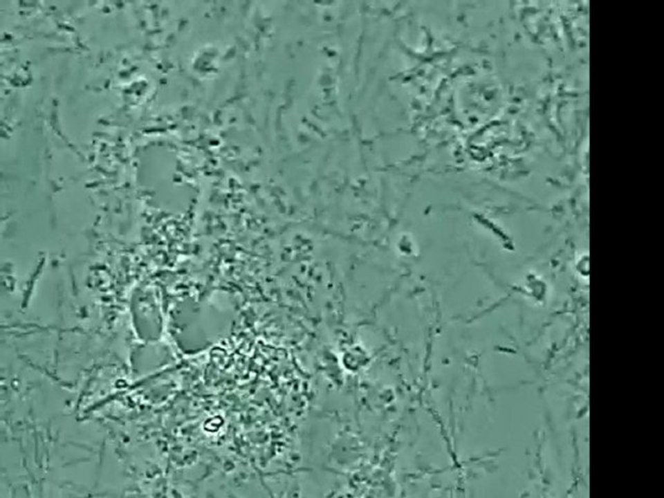 Attaque d'une dent - Le traitement laser de la maladie Parodontale .