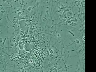 Attaque d'une dent - Le traitement laser de la maladie Parodontale .