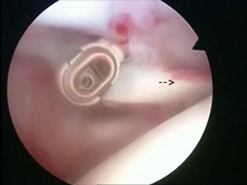 Tendon du long biceps pathologique vu sous arthroscopie