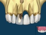 Implantes dentales o puentes dentales