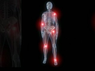 A Better Understanding Of Uric Acid Gout