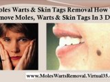 how to get rid of skin tags - wart removal home remedies