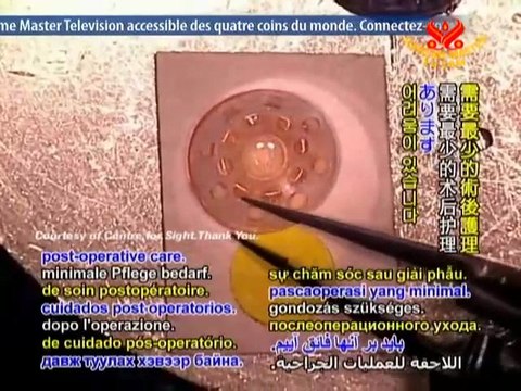 Dr. Sheraz Daya: Corneal Transplantation - P1/2
