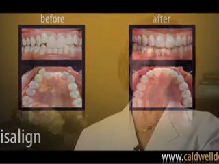 Invisalign® Clear Braces - Caldwell DDS - Orange County, California