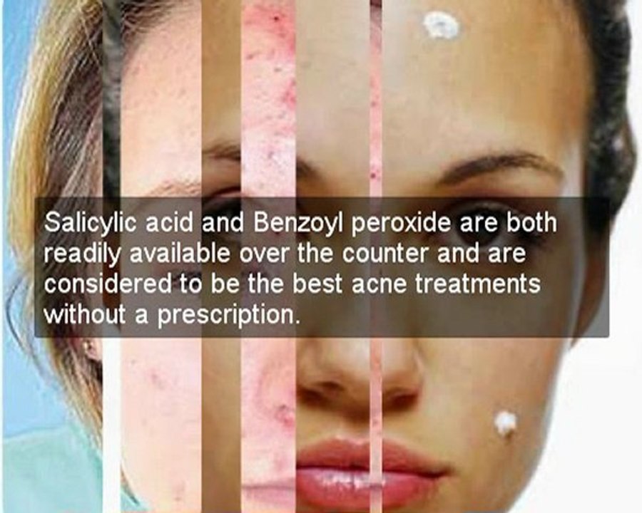 back acne treatment