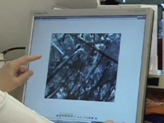 Esen Pamukçu- Dermozinç tedavilerinin Etkileri nelerdir ?