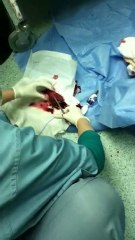 tumer and stones in agall bladder